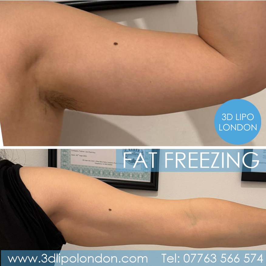 Coolsculpting Before and After