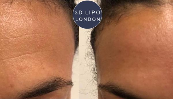 3D HydrO2 facial before and after - Belgravia client with even skin tone