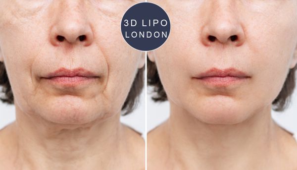 Anti-aging facial before and after - Bloomsbury client looking 10 years younger