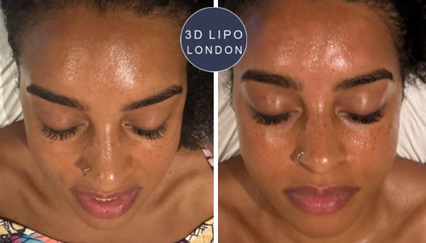 3D HydrO2 facial anti-aging results - Westminster client
