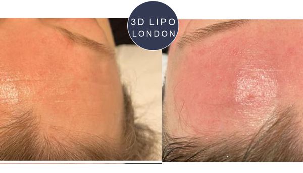 3D HydrO2 facial before and after - Camden client with cleared skin