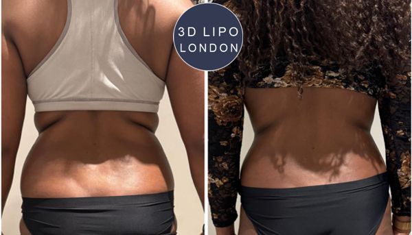 Ultrasound cavitation before and after results - back