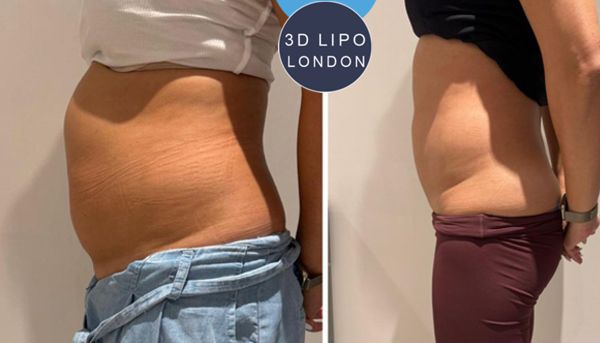 Ultrasound cavitation before and after results - abdomen fat reduction