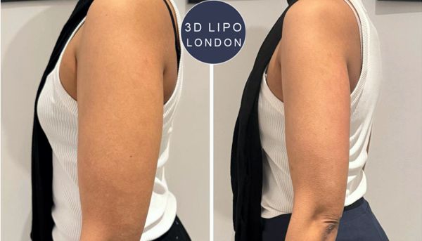 Arm cavitation before and after results - Regent's Park client showing slimmer arms