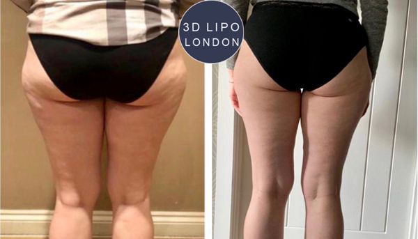 Cellulite treatment before and after