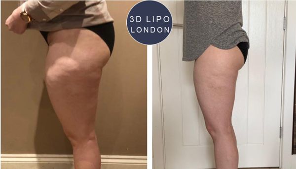 Cellulite reduction treatment results on buttocks - Baker Street area client