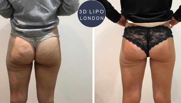 Cellulite treatment before and after results showing improved skin texture