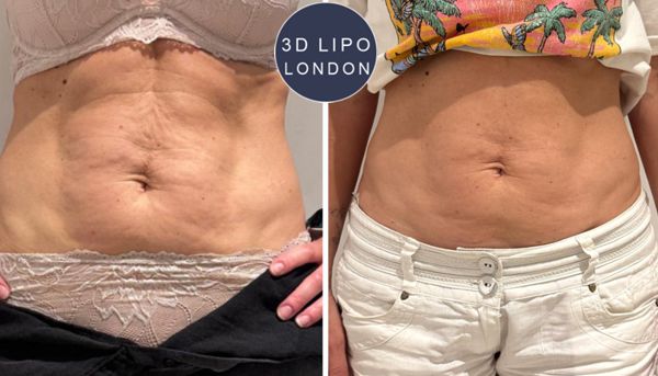 Stomach cellulite before and after - Hampstead client showing skin smoothing