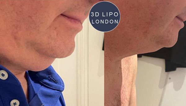 Double chin reduction with fat freezing - Westminster client