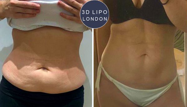 Fat freezing before and after results showing dramatic body transformation