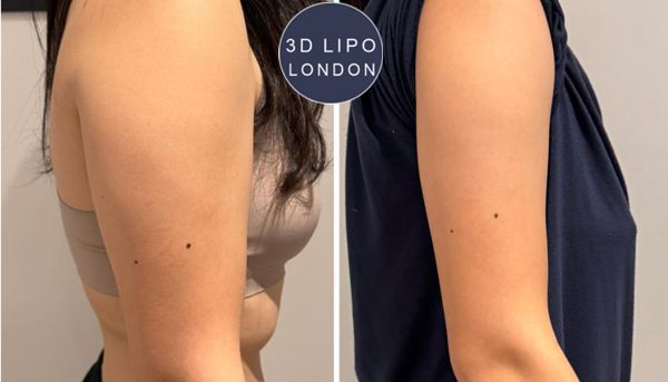 Arm fat freezing before and after photos - Fitzrovia client showing toned upper arms
