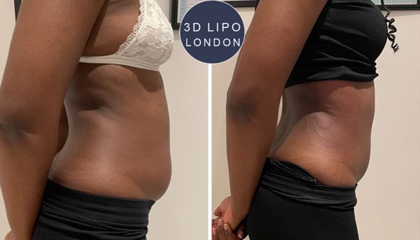 Stomach fat freezing before and after results - Marylebone client