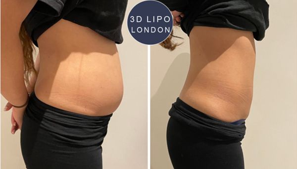 Love handles fat freezing transformation - Baker Street area client
