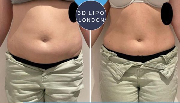 PowerSculpt abdomen treatment results - Baker Street area client