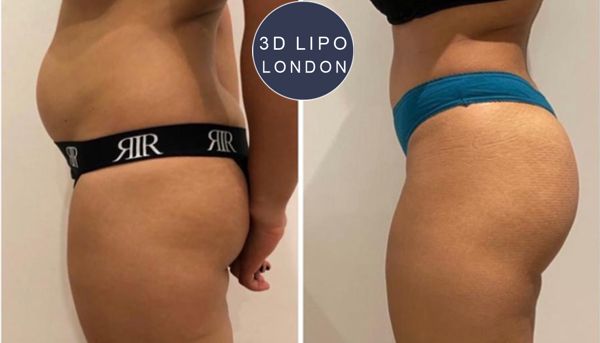 PowerSculpt buttock lift results - Westminster client