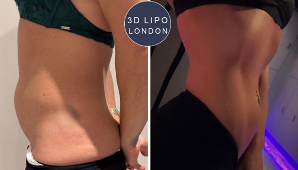 Before and after PowerSculpt muscle toning treatment