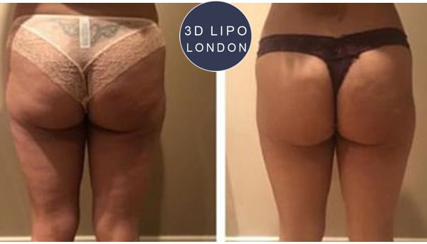 Shockwave therapy before and after results showing visible cellulite reduction and skin improvement