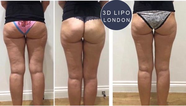 Shockwave therapy skin tightening results - Westminster client