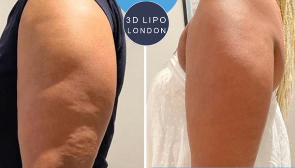 Radio frequency skin tightening before and after results showing visible lifting and firming