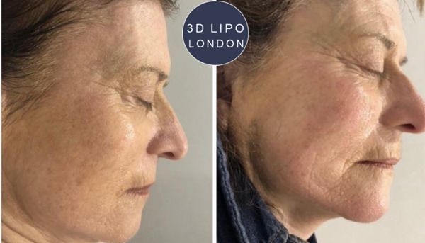 Radio frequency skin tightening before and after stomach - Kensington client post-pregnancy results
