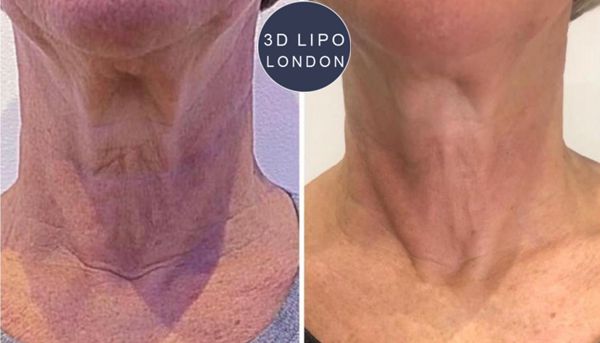 Skin tightening treatment before and after results showing improved skin texture