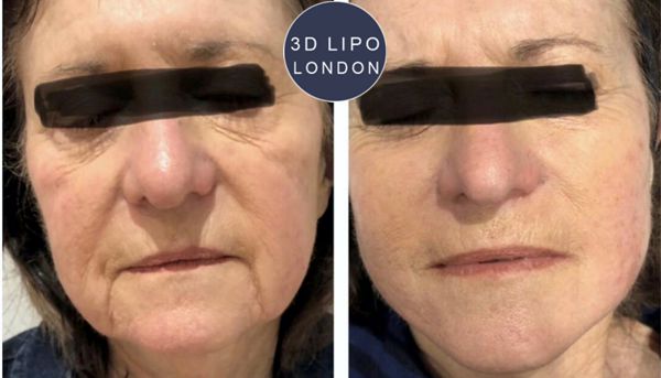 Skin tightening face treatment before and after results
