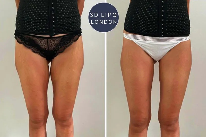 non-surgical treatments before and after results showing 8 shades lighter transformation at our London clinic
